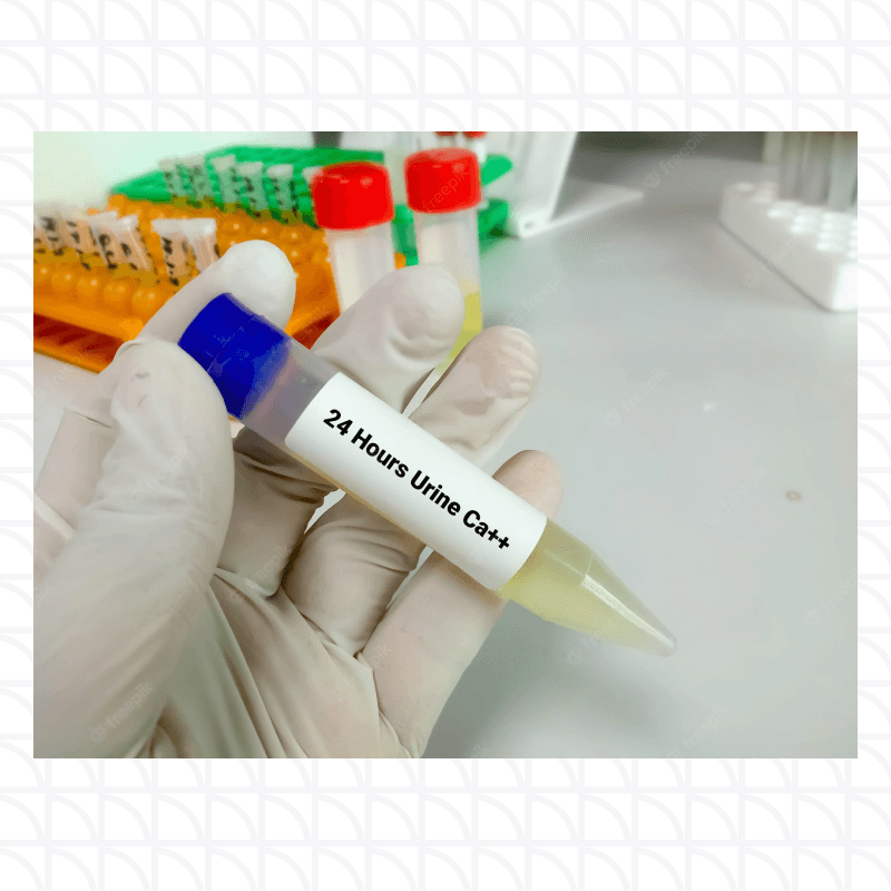 24-Hour Urine Calcium Test